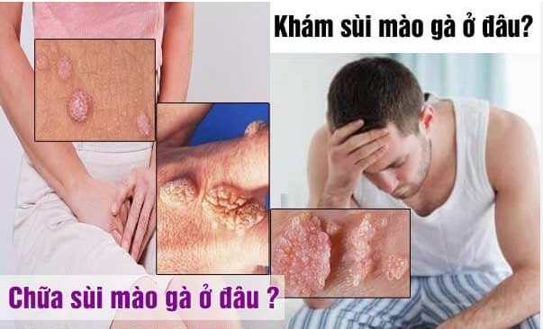 10 Địa chỉ khám chữa bệnh sùi mào gà ở đâu tốt nhất Hà Nội