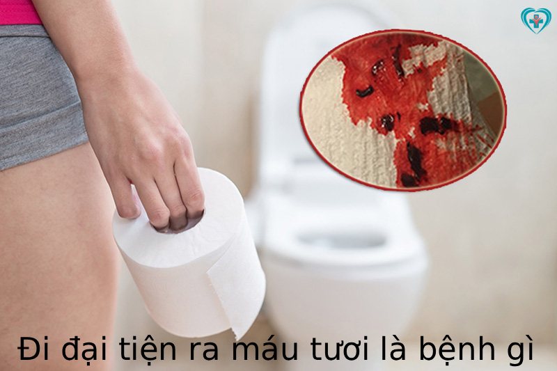 đi đại tiện ra máu tươi