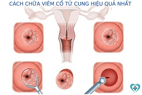 cách chữa viêm cổ tử cung
