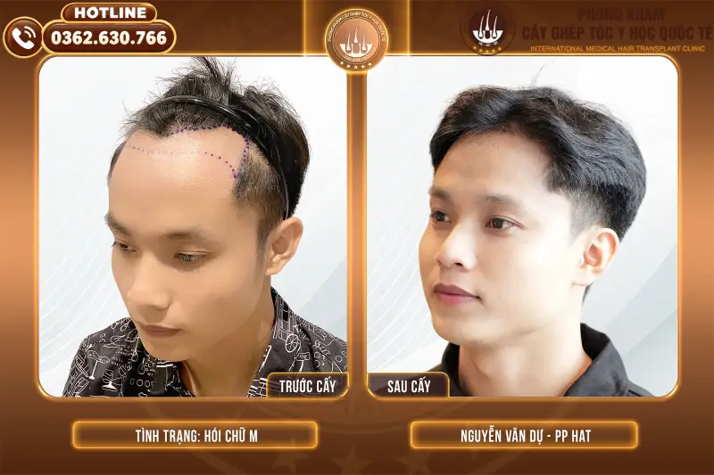 Hói đầu là gì