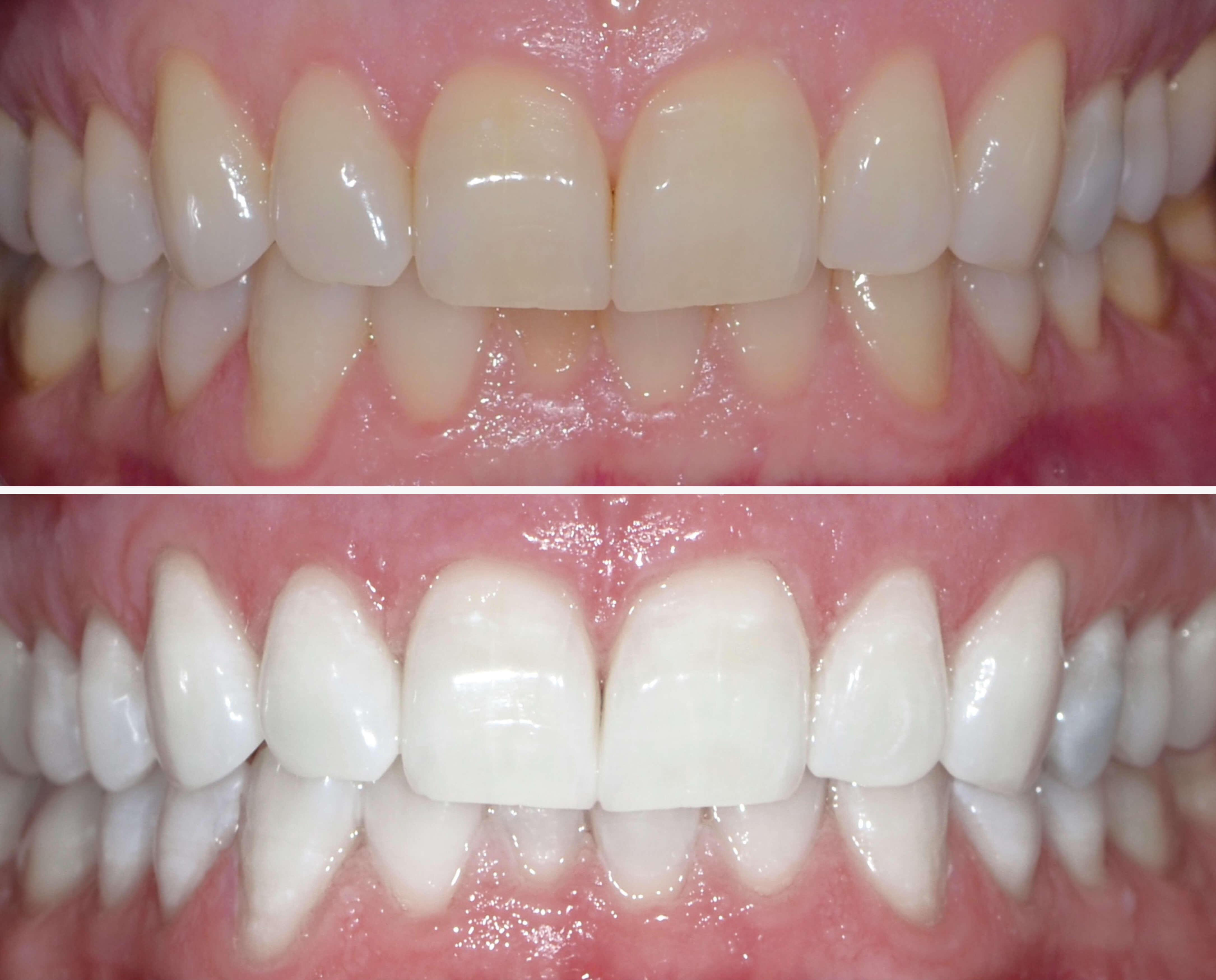 Patient’s teeth before and after receiving Philips Zoom! in-chair teeth whitening at le tooth