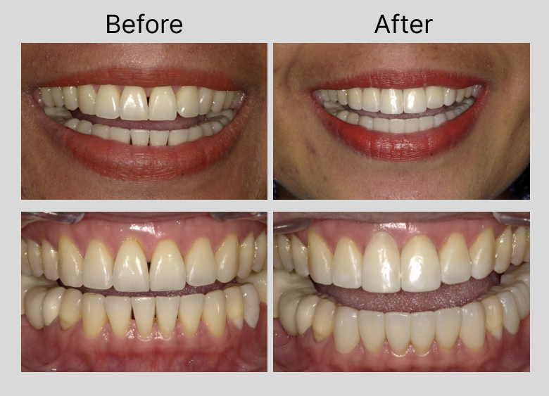 Composite Veneers Chandler, AZ