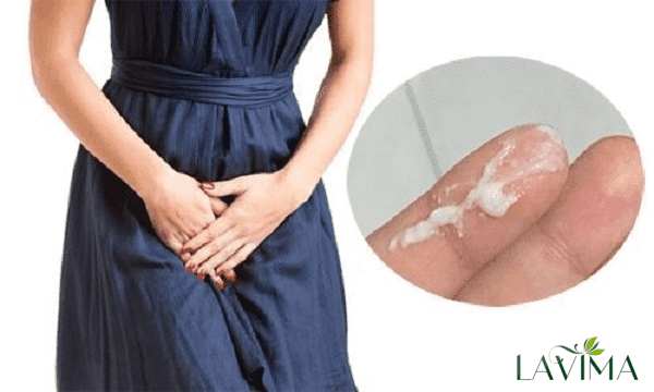 các bước chữa viêm phụ khoa nặng bạn cần làm là gì?