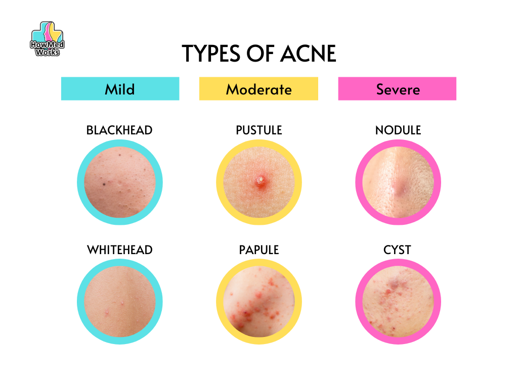 types of acne diagram