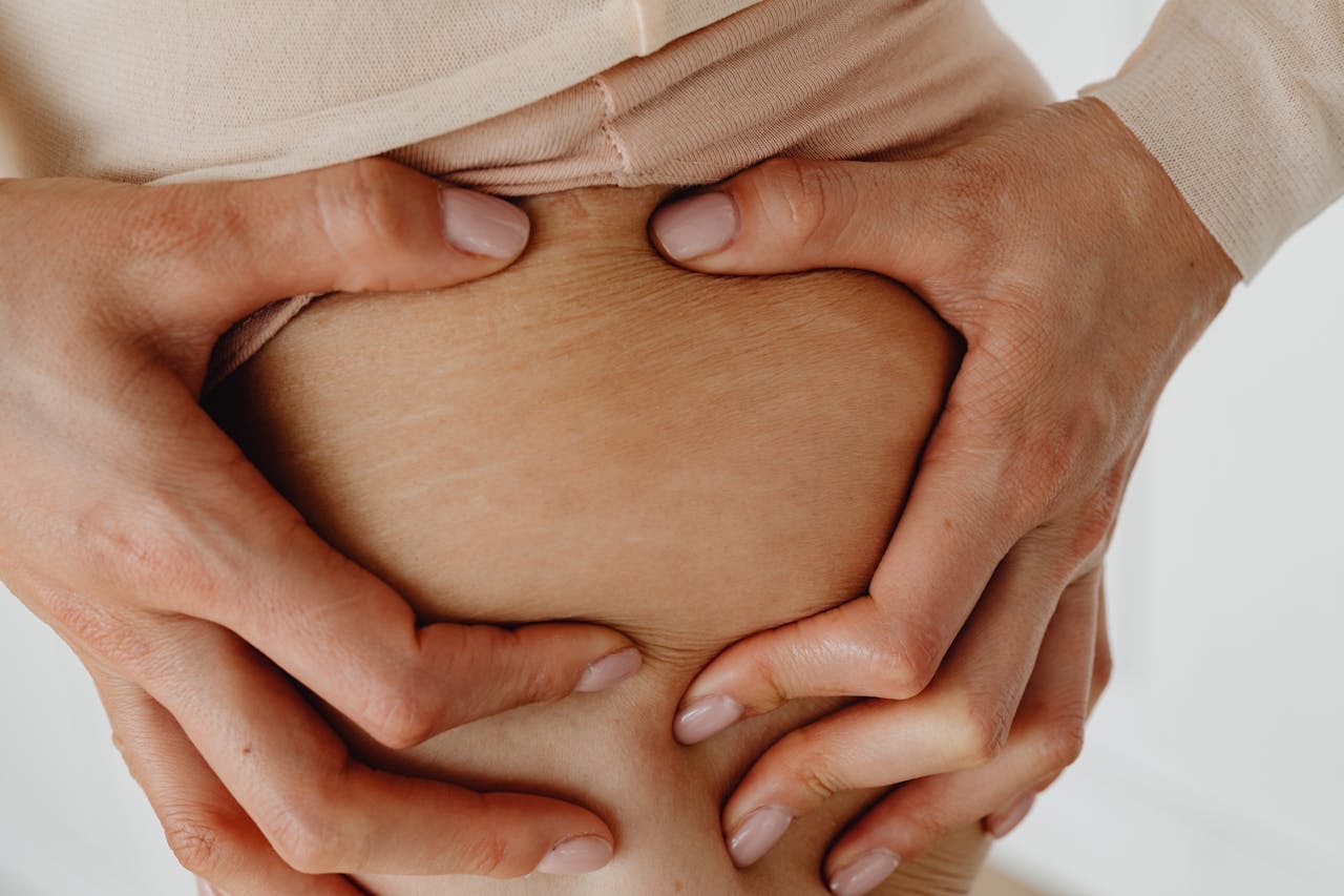 eoman examining the skin on her upper thigh, on which stretch marks are faintly visible