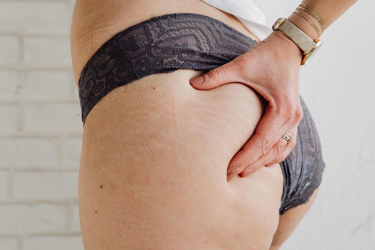 woman examining stretch marks in a mirror