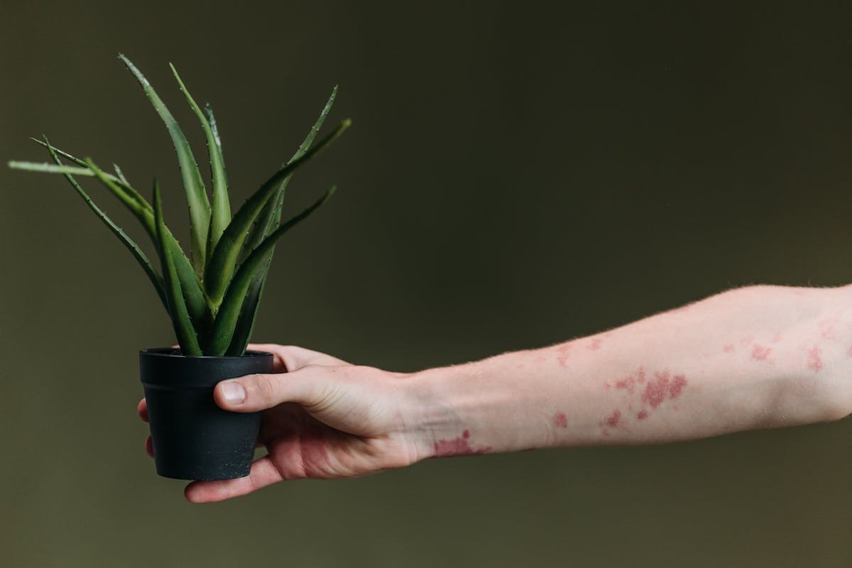 person with eczema holding an aloe vera plant