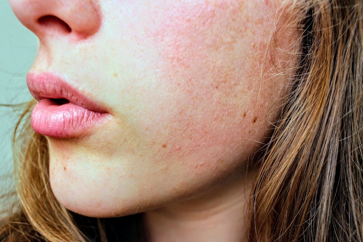 woman with eczema having a flare up that leaves her cheeks looking red