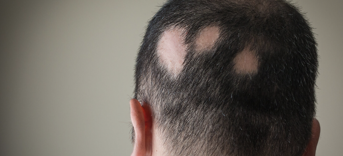 man with alopecia related bald spots