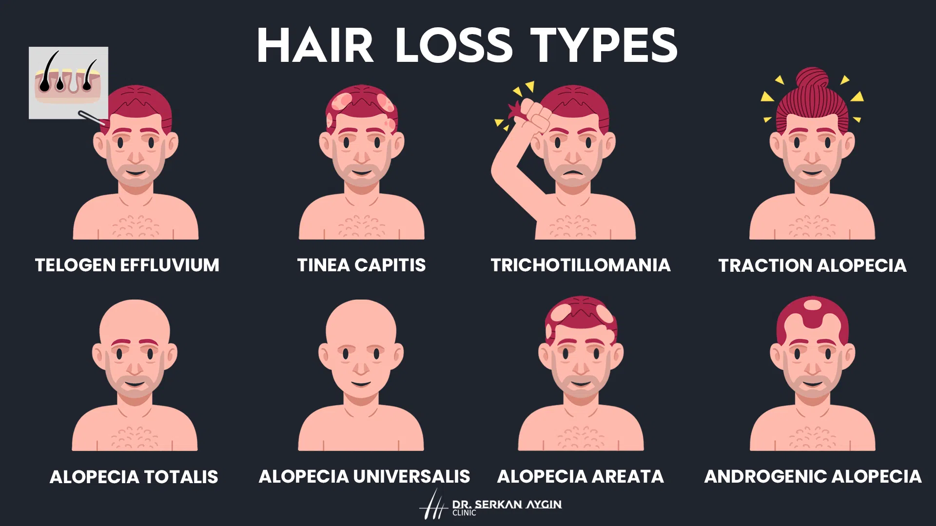 hair loss types infographic