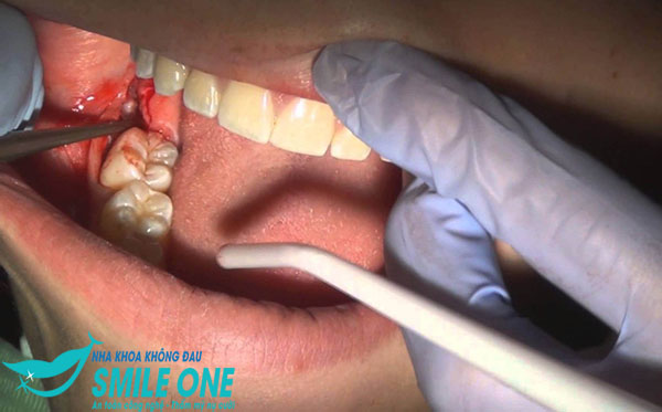 nho-rang-so-8-ham-duoi-1