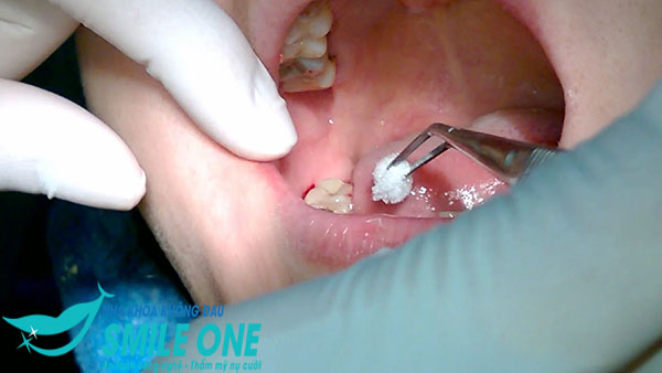 nho-rang-so-8-ham-duoi-2