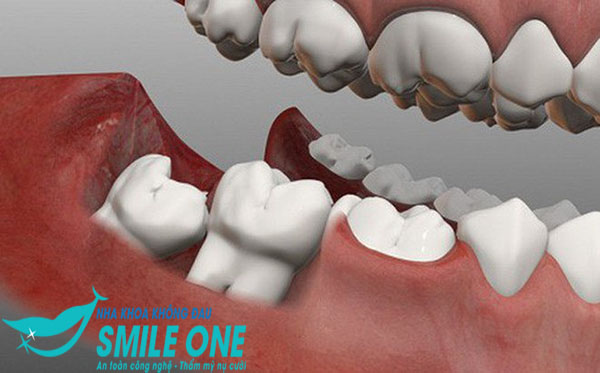 nho-rang-so-8-ham-duoi