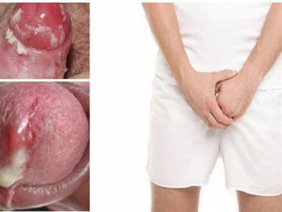Bệnh lậu là gì?