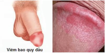 hẹp bao quy đầu gây viêm bao quy đầu
