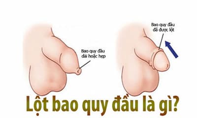 Cách lột bao quy đầu