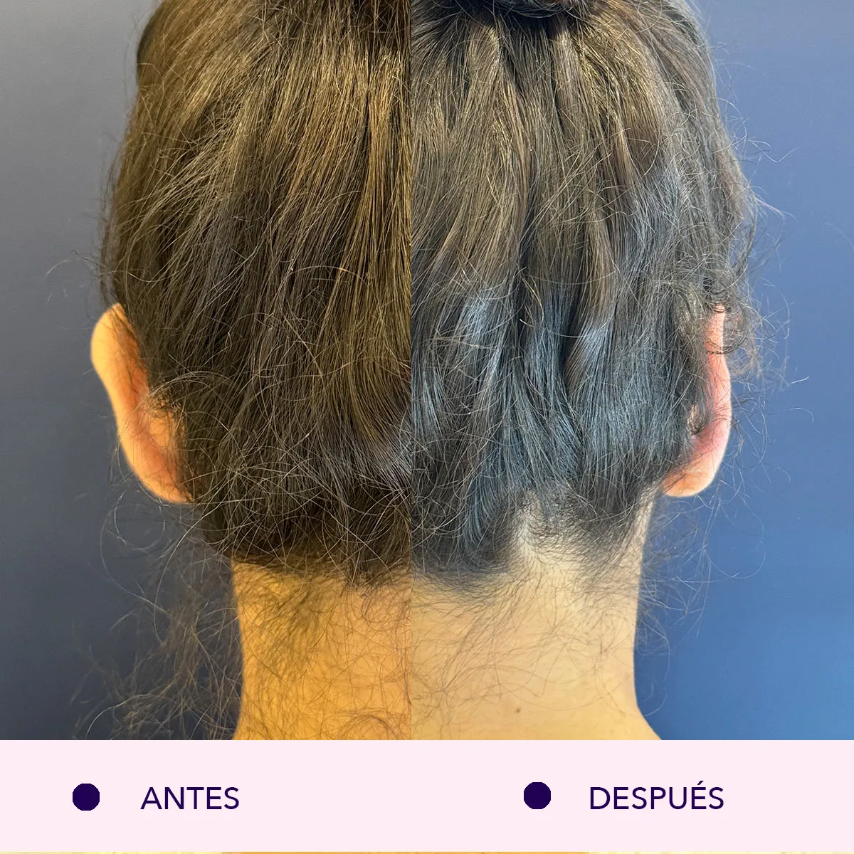 otoplastia antes y después