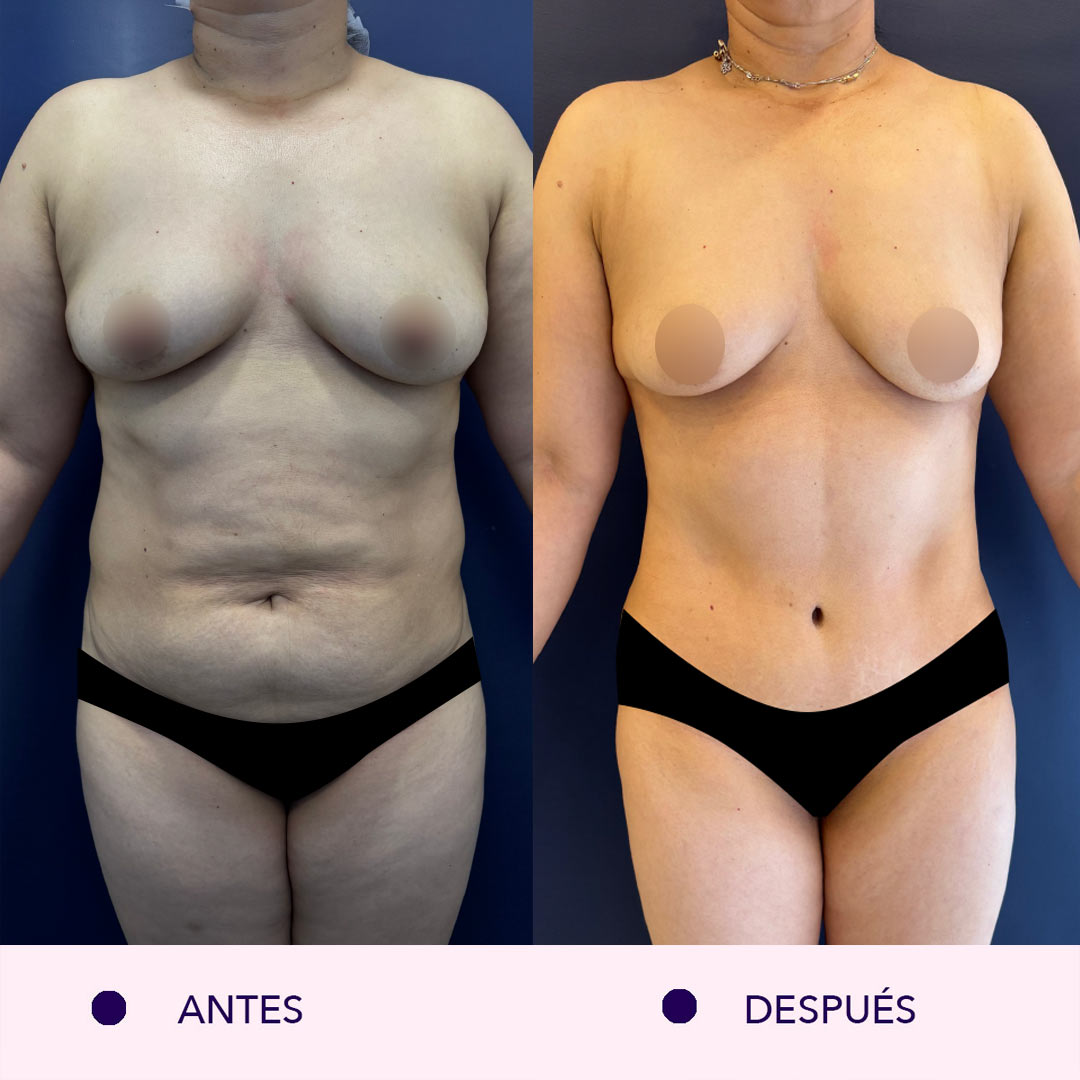 Antes y despues lipoabdominoplastia bogotá