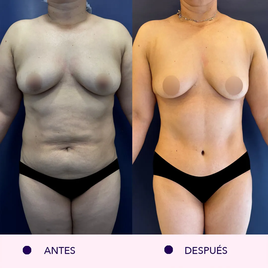 Antes y despues lipoabdominoplastia bogotá