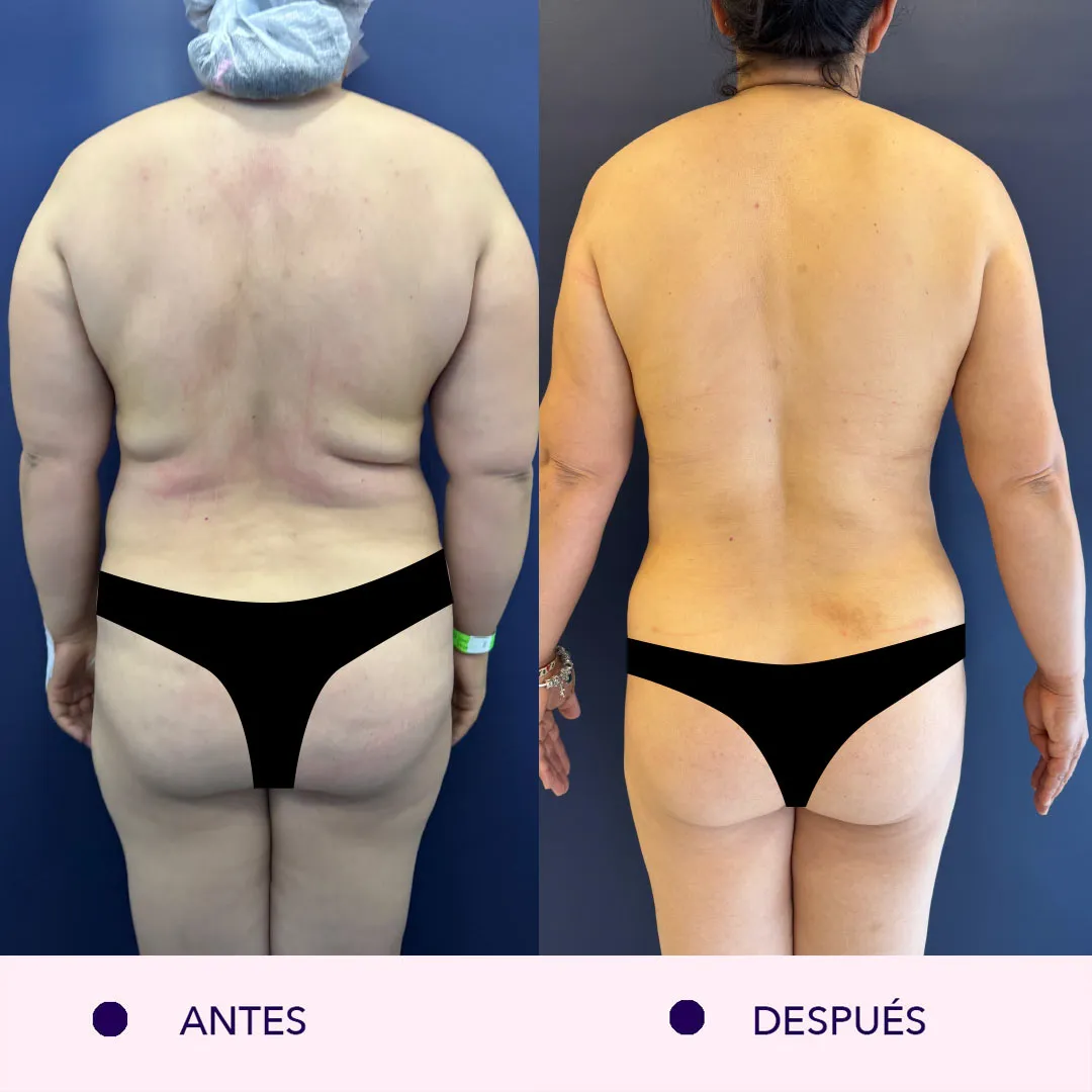 Antes y despues lipoabdominoplastia bogotá
