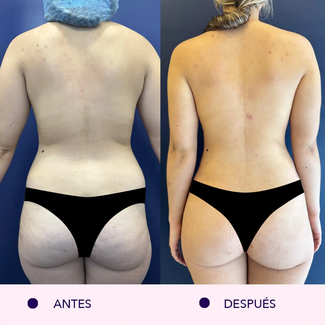 Antes y despues lipoabdominoplastia bogotá