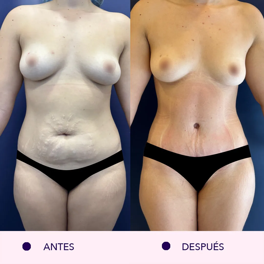 Antes y despues lipoabdominoplastia bogotá