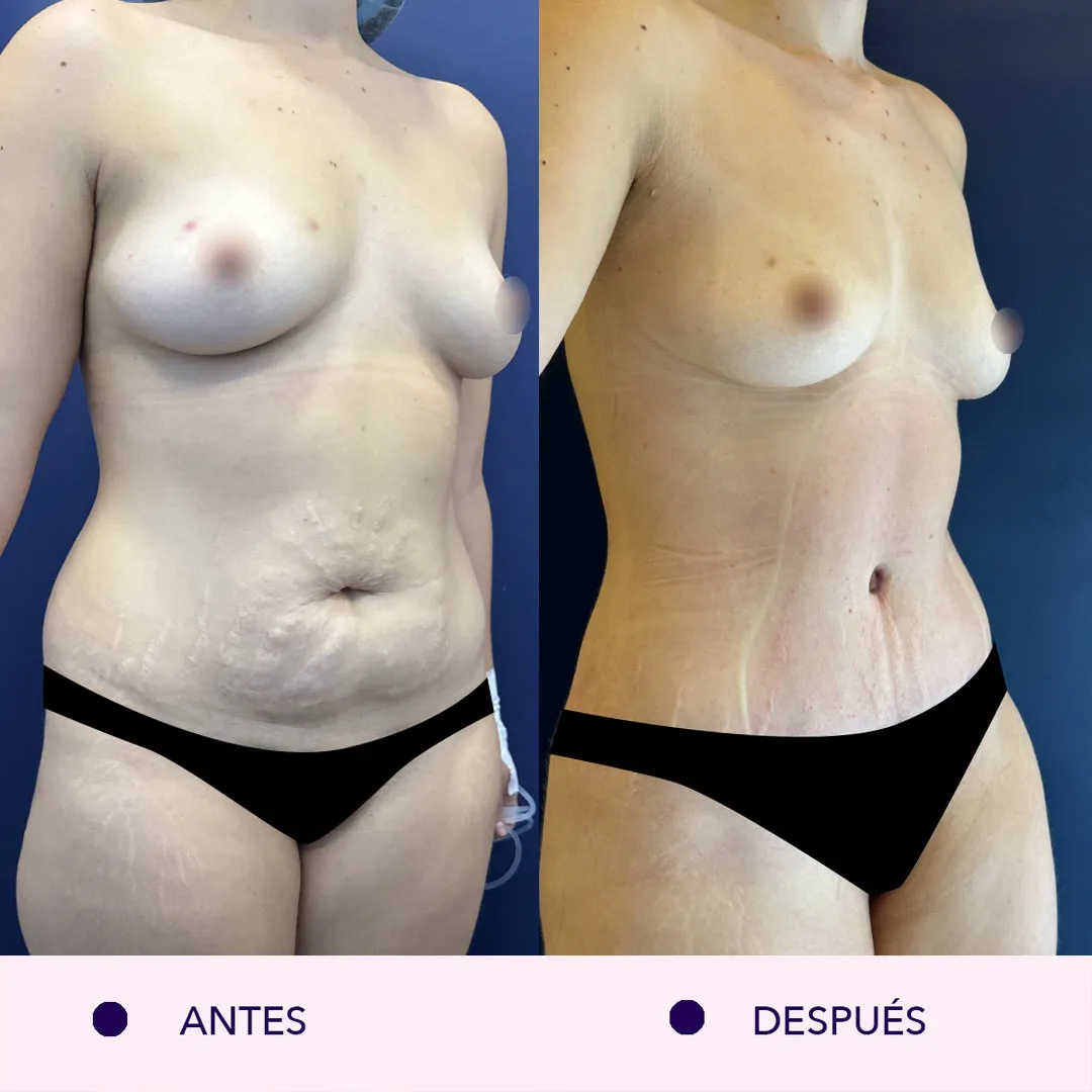 Antes y despues lipoabdominoplastia bogotá