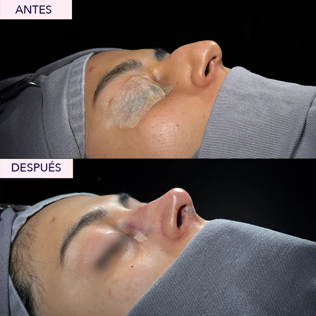 antes y despues rinoplastia en bogota