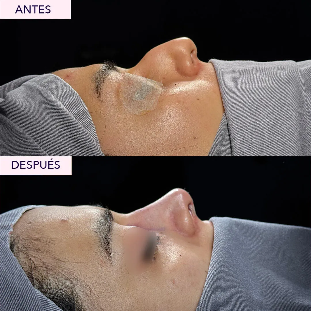 antes y despues rinoplastia en bogota