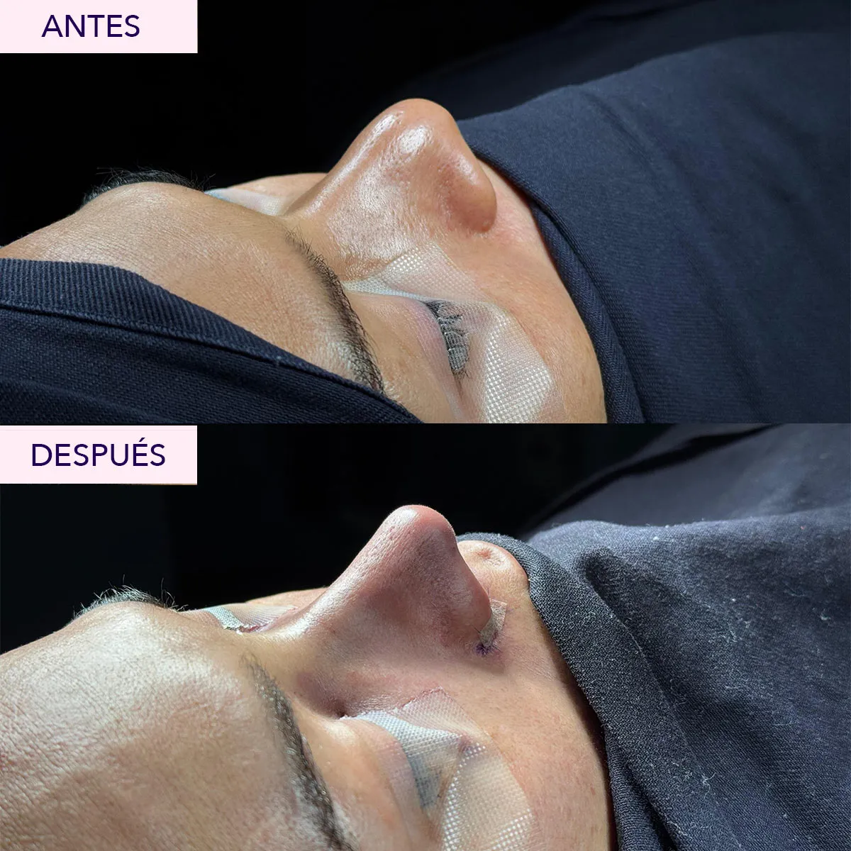 antes y despues rinoplastia en bogota