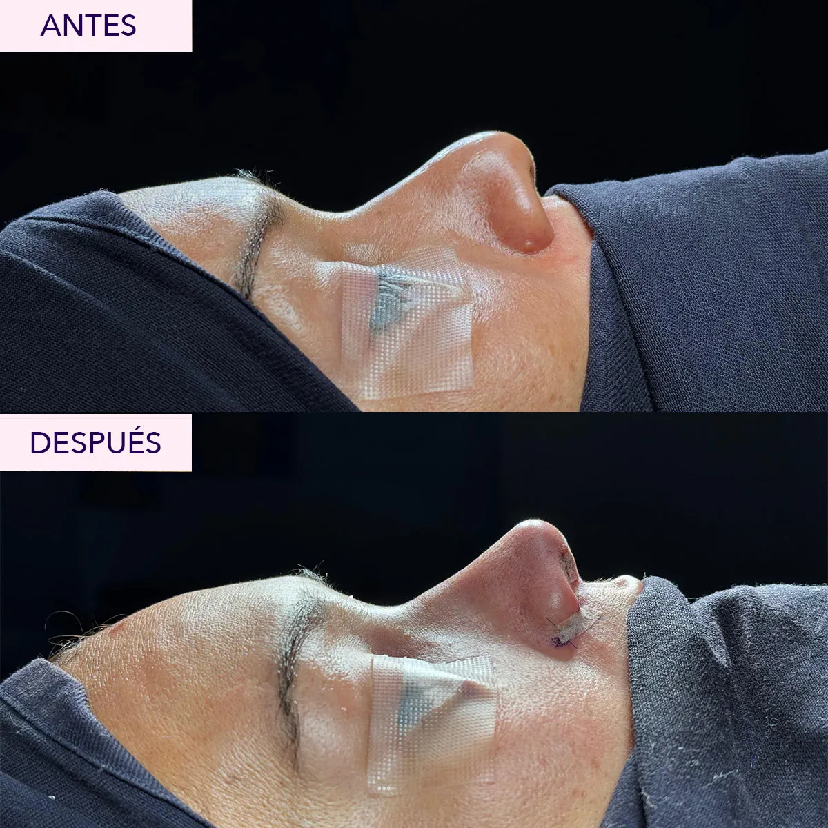 antes y despues rinoplastia en bogota