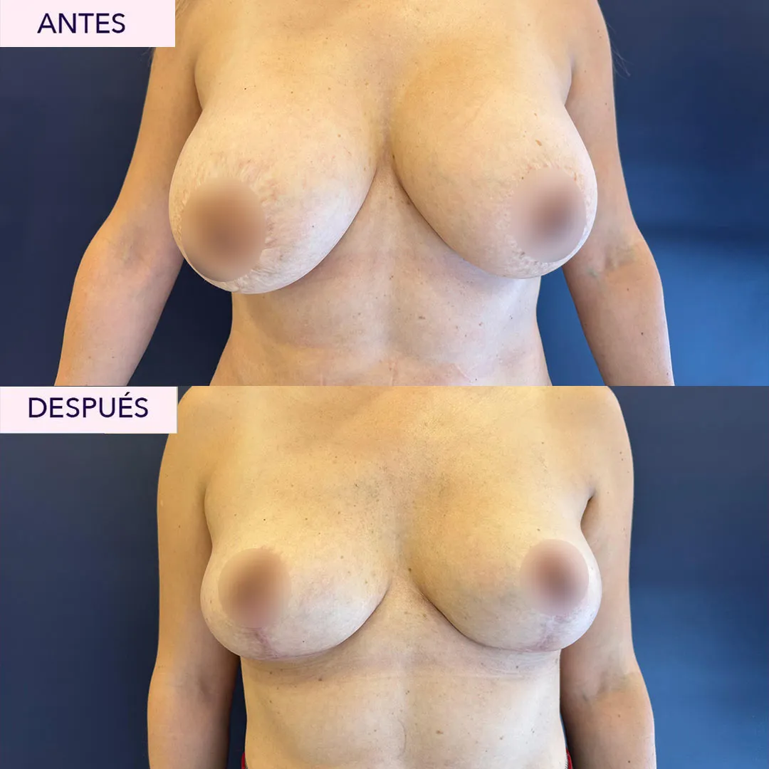 Antes y después explantación mamaria en Bogotá
