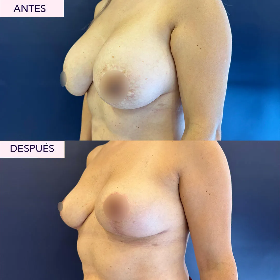 Antes y después explantación mamaria en Bogotá
