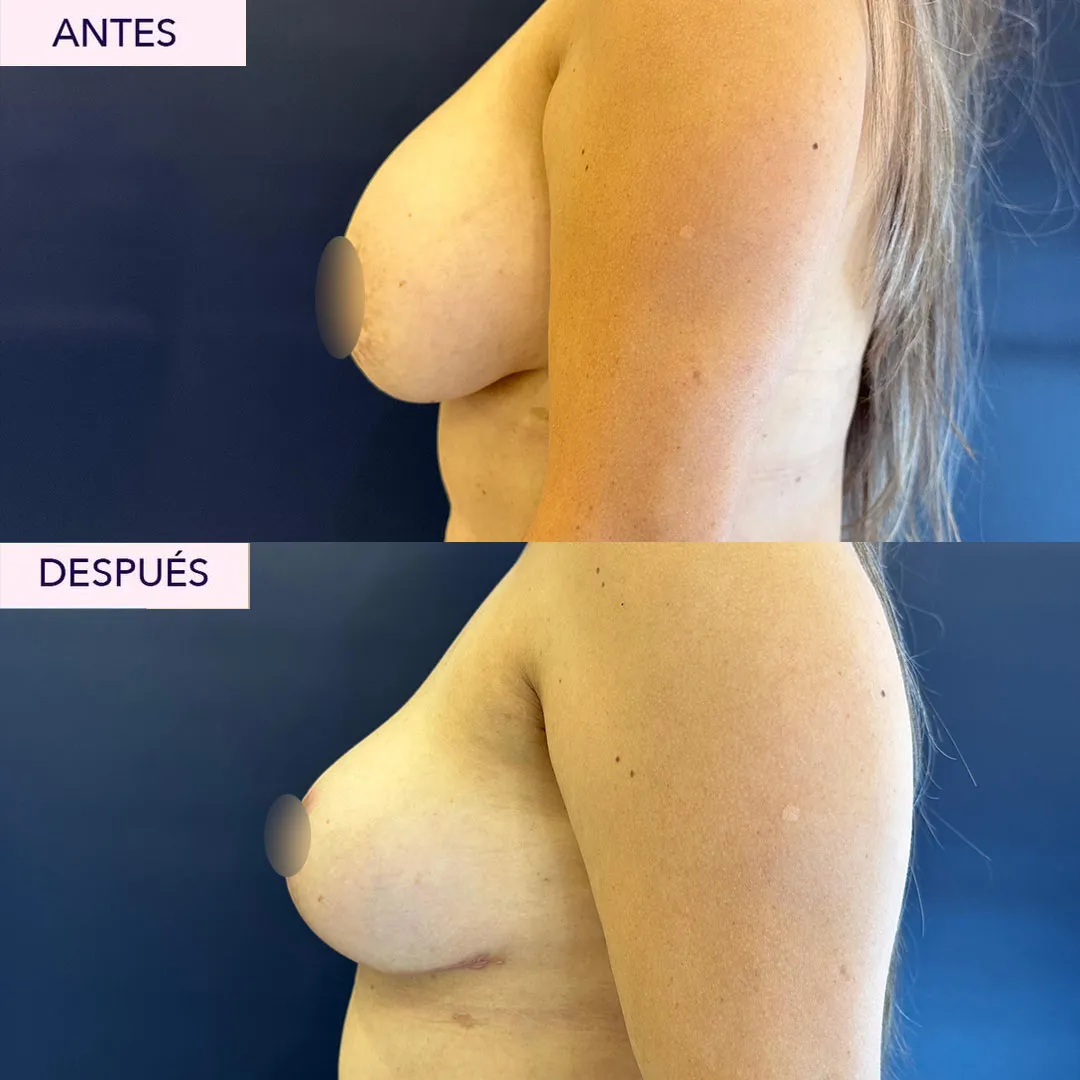 Antes y después explantación mamaria en Bogotá