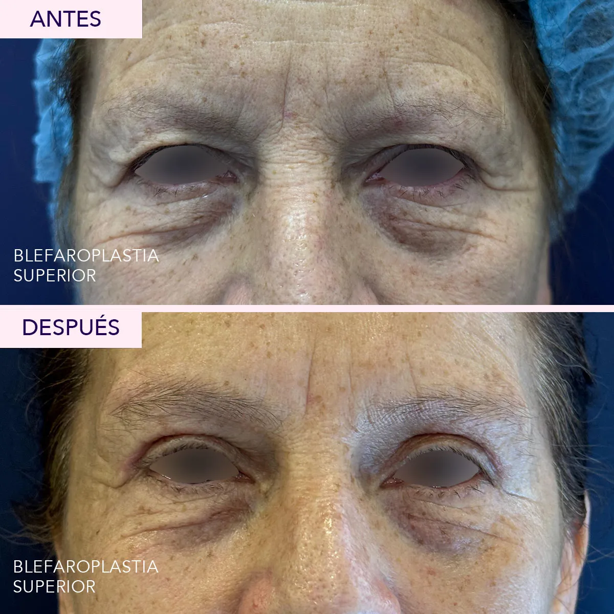 Antes y después blefaroplastia superior en Bogotá