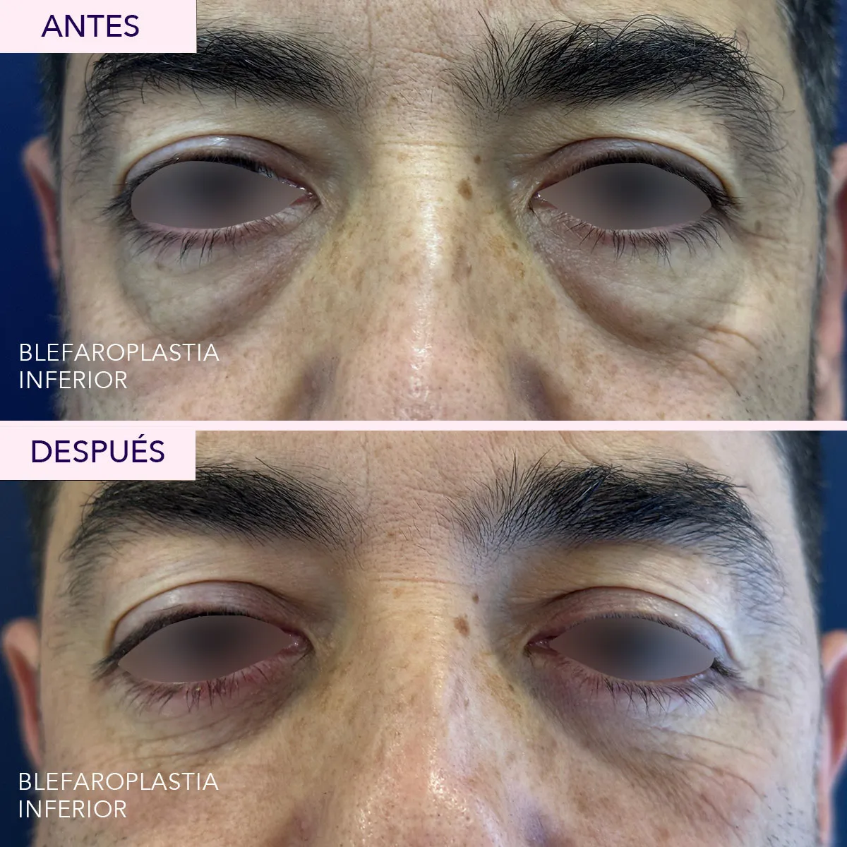 Antes y después blefaroplastia inferior masculina en Bogotá