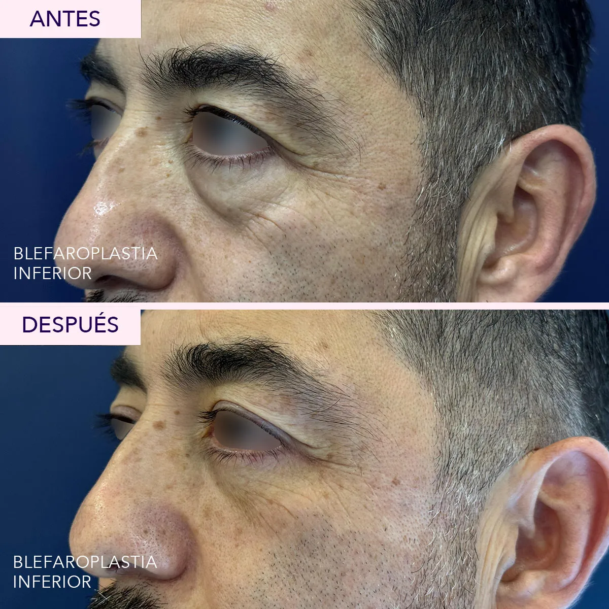 Antes y después blefaroplastia inferior masculina en Bogotá