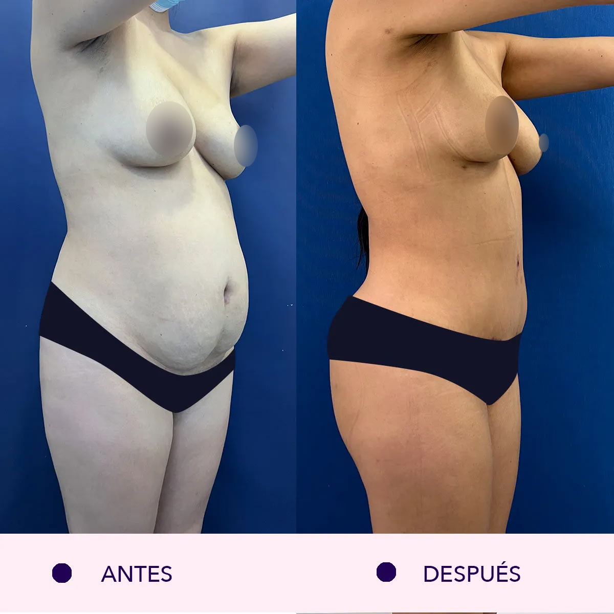 Lipoabdominoplastia antes y después en bogotá