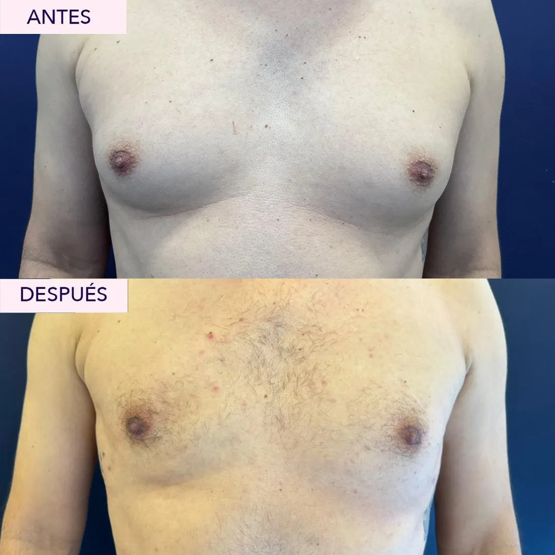 Antes y después cirugía ginecomastia