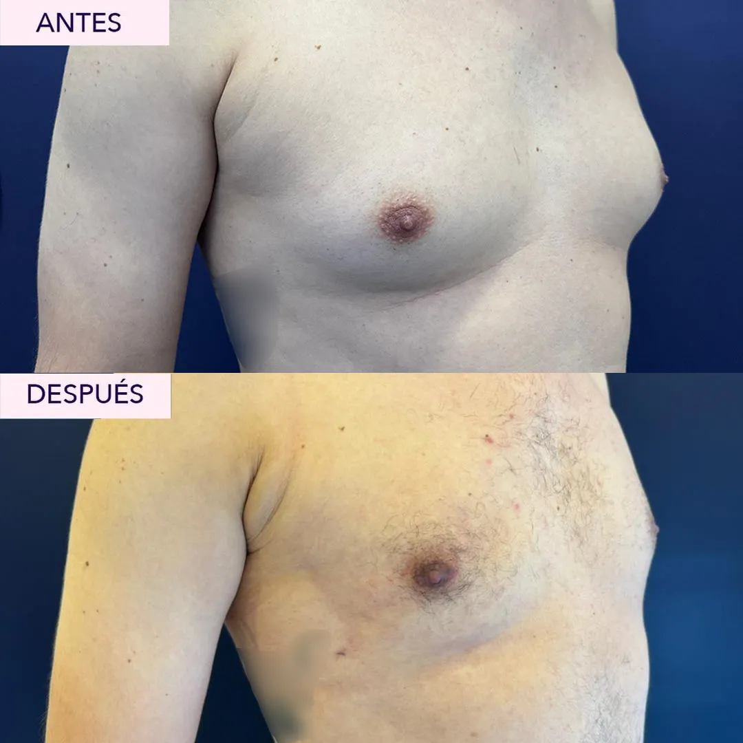 Antes y después cirugía ginecomastia
