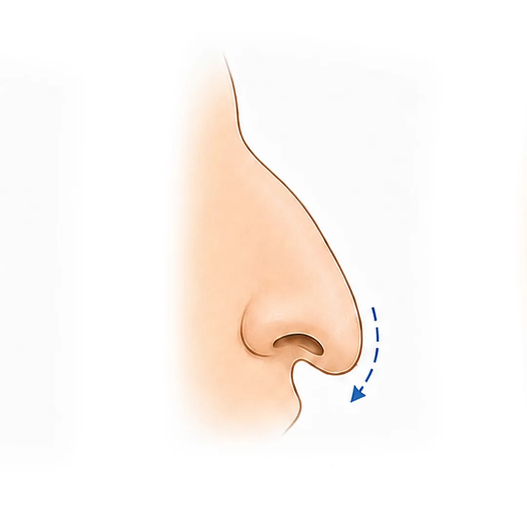 zona de la nariz que se corrige con rinoplastia