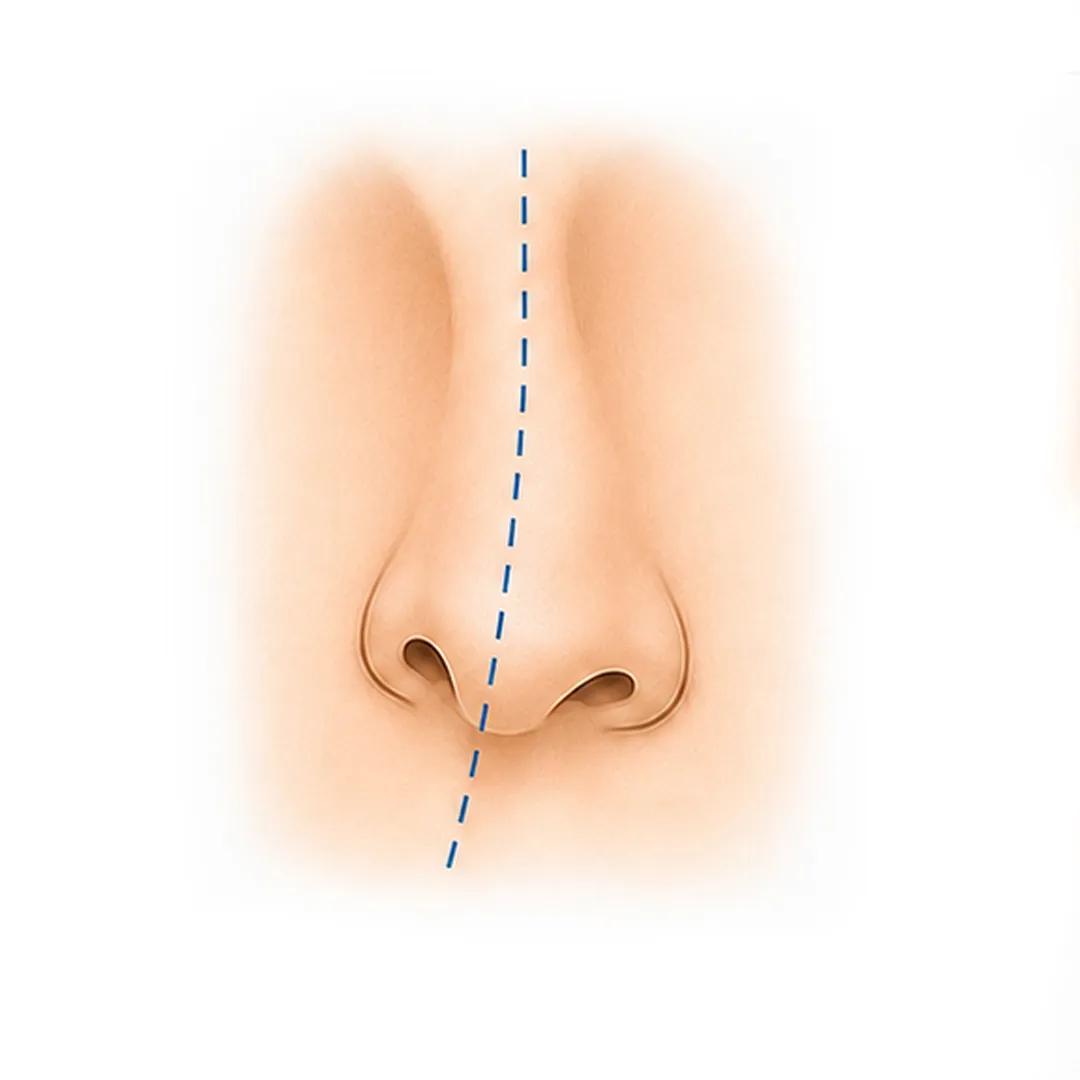 zona de la nariz que se corrige con rinoplastia