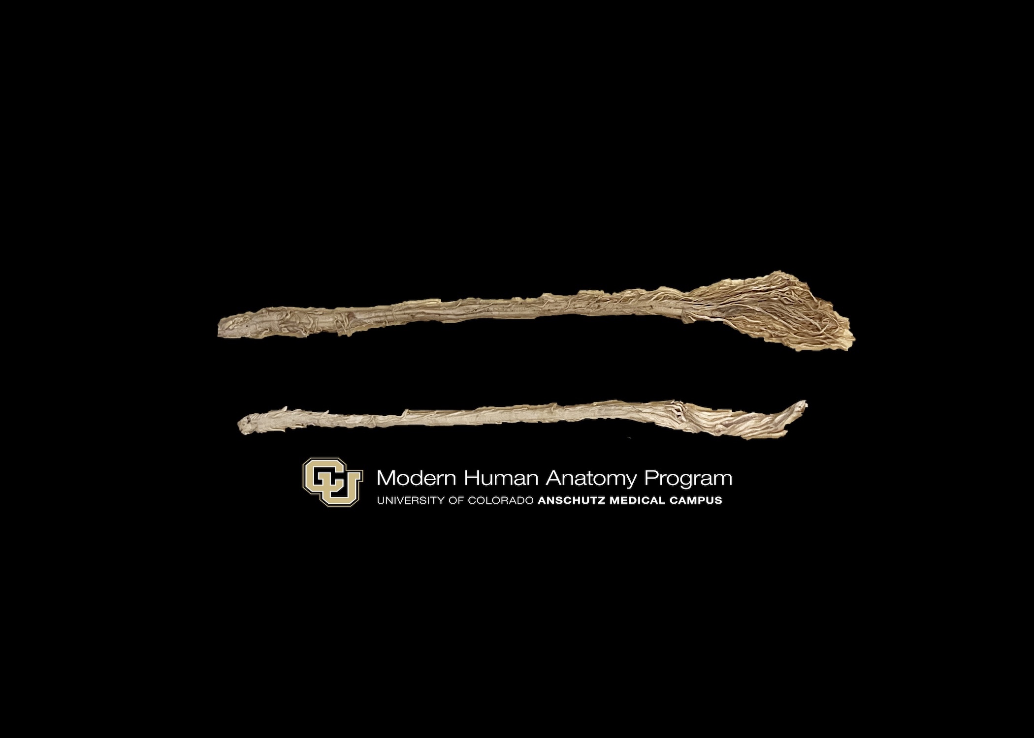 two spinal cords, one healthy and one with multiple sclerosis