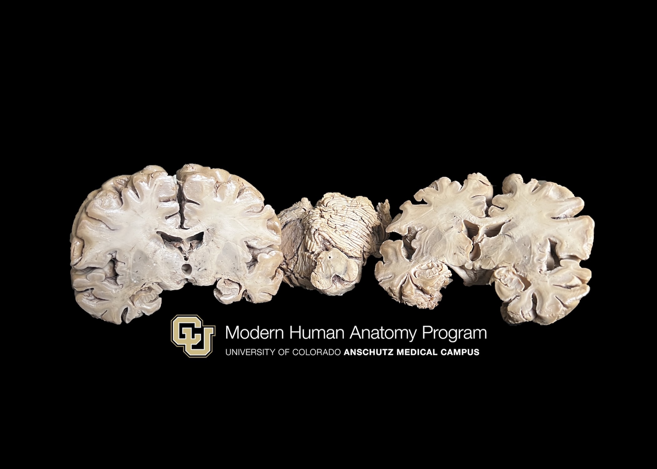 Brain with alzheimer's disease and PD features