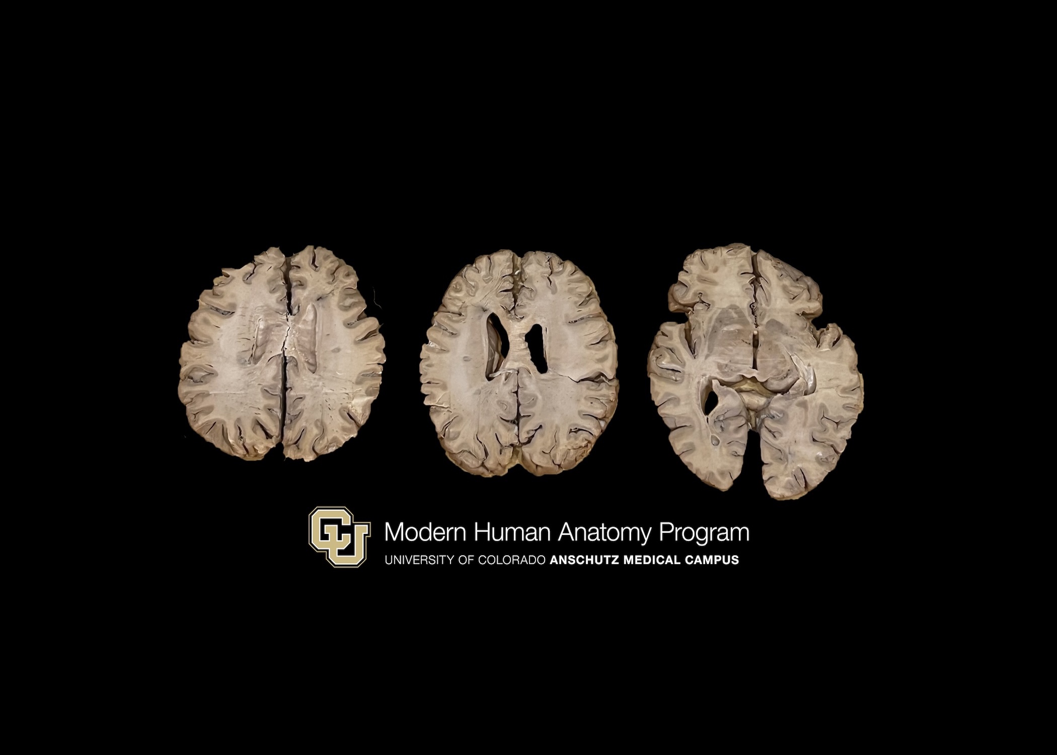 Axial slices of brain with Multiple sclerosis (3 pieces)