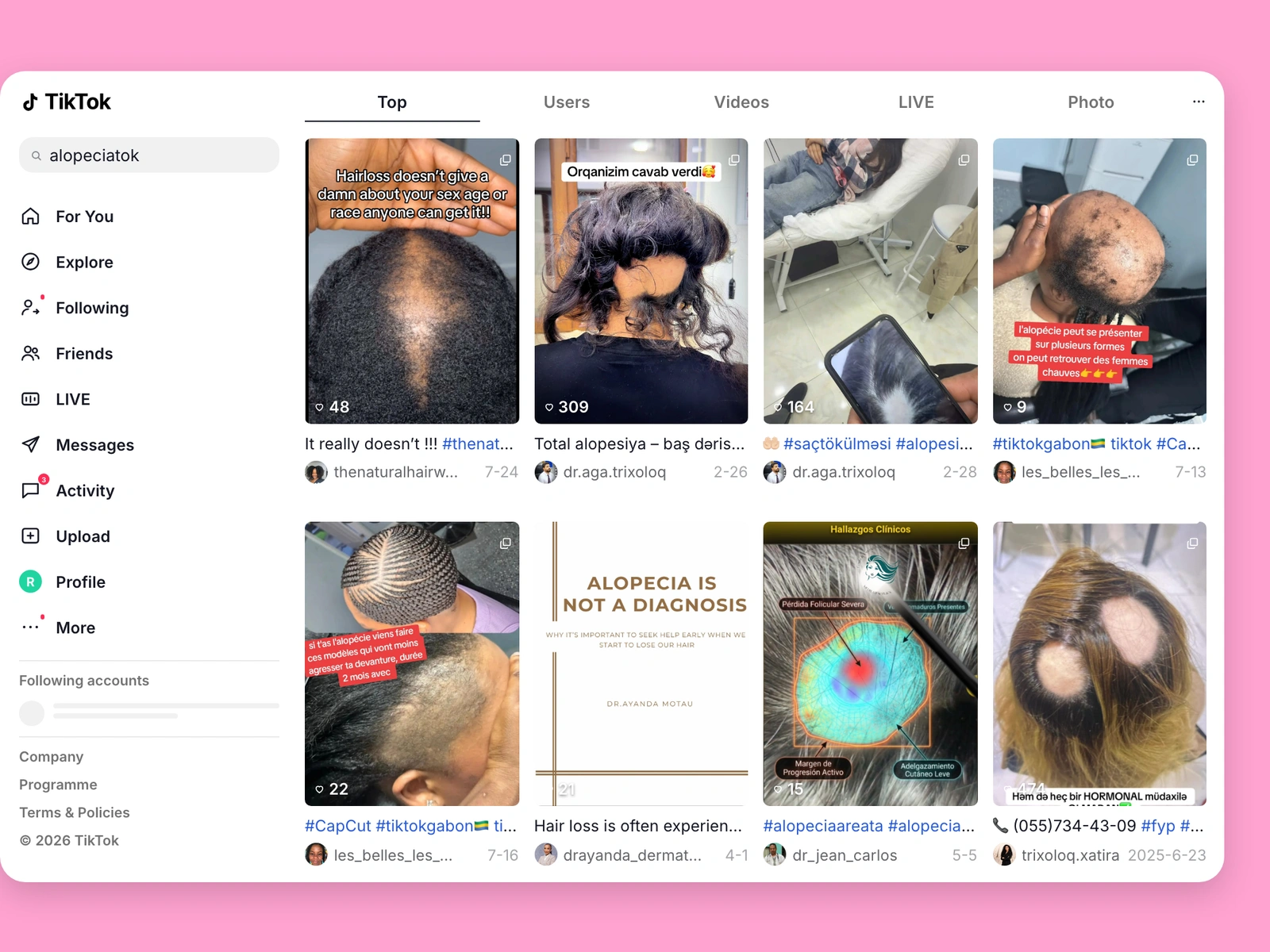 TikTok search results for alopecia content