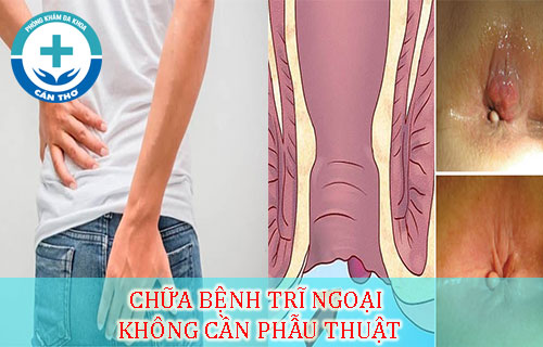 Chữa bệnh trĩ ngoại không cần phẫu thuật
