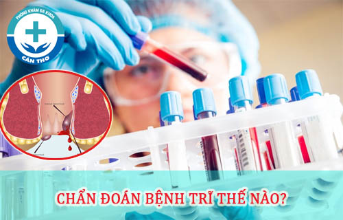 chẩn đoán bệnh trĩ ngoại