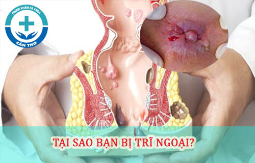 nguyên nhân bệnh trĩ ngoại