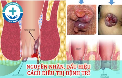 bệnh trĩ nội để lâu có sao không